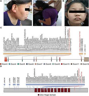 Expanding the mutational and clinical spectrum of Chinese intellectual disability patients with two novel CTCF variants